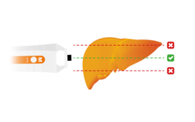 惠及更多患者！FibroScan 肝功能剪切波量化超声诊断仪相关检测项目纳入多地医保